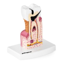 Model anatomiczny chorego zęba człowieka w skali 6:1